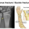 Greenstick Fracture: A Guide for Healthcare Professionals