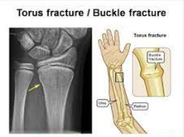 Greenstick Fracture: A Guide for Healthcare Professionals